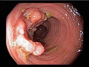 Colonoscopy example image showing a colorectal polyp / lesion